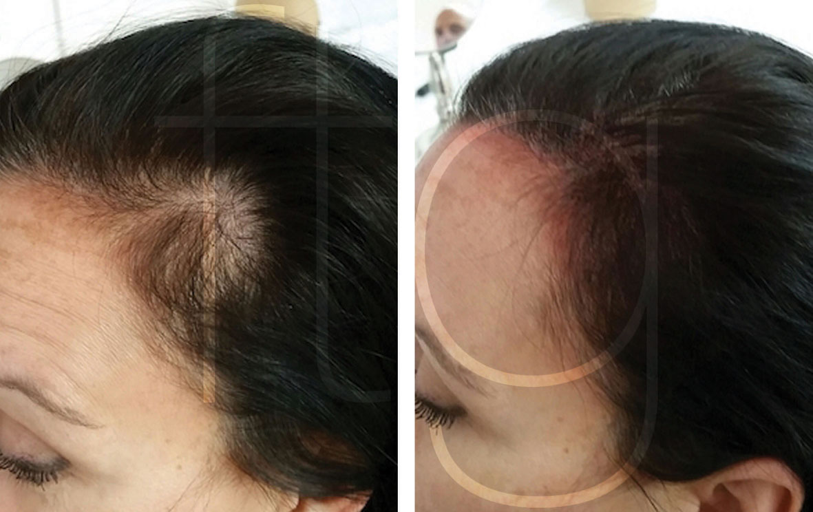 VYTAL Scalp Micropigmentation before and after treatment